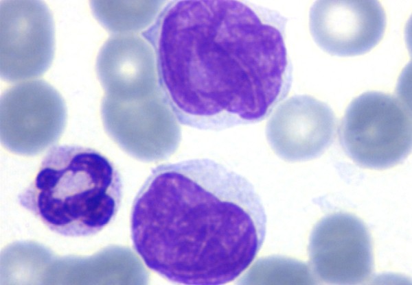 Herramienta diagnóstica en leucemias y linfomas's header image